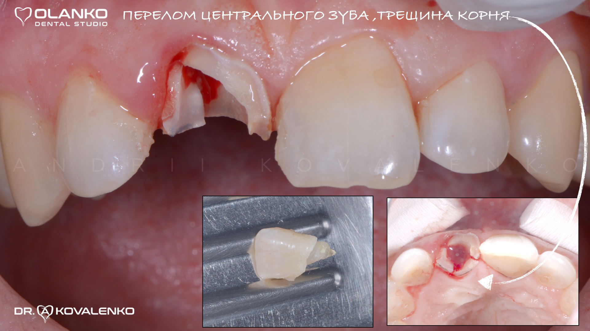 Зуб за один день Імплант на верхній передній зуб | Olanko